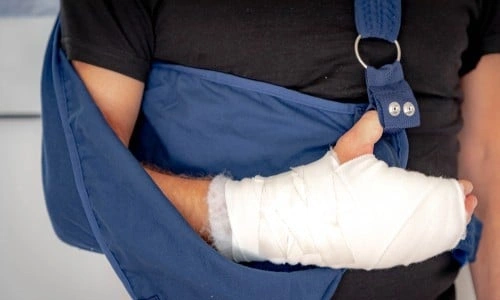 How Much Is a Finger Worth in a Lawsuit?