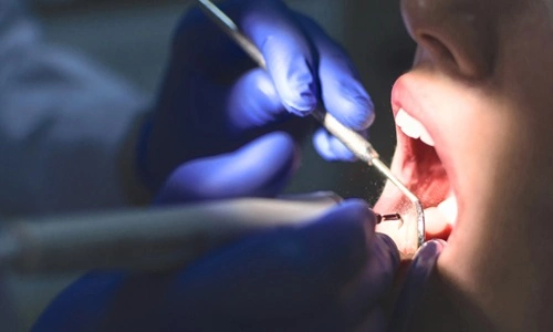 How Much Is a Tooth Worth in a Lawsuit?