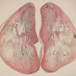 Alabama Mesothelioma Cases