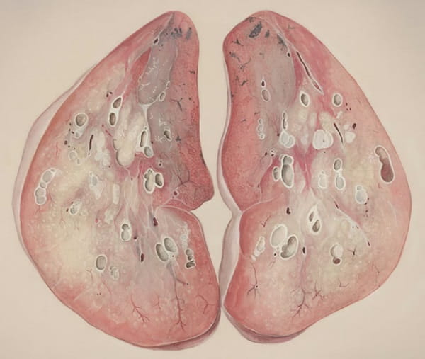 Alabama Mesothelioma Cases