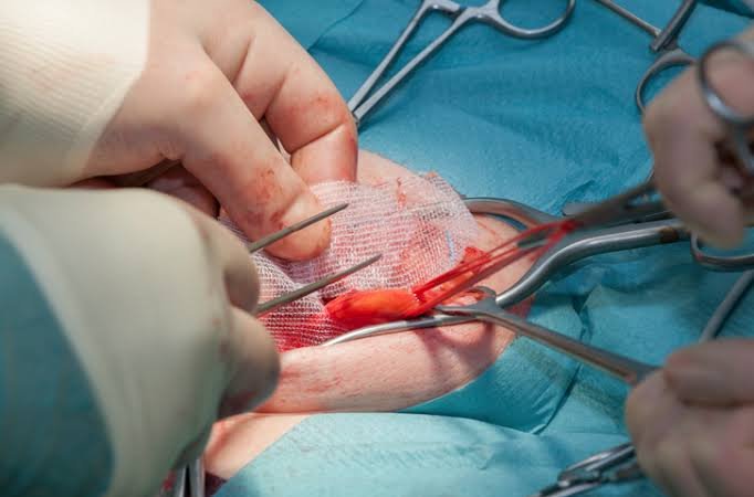 Hernia Mesh Lawsuits